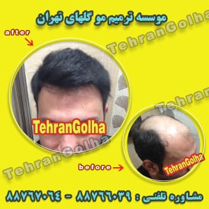 عوارض ترمیم مو گلهای تهران ترمیم موی بانوان و آقایان هزینه کاشت مو معایب روش ترمیم مو چیست
