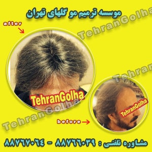 عوارض ترمیم مو گلهای تهران ترمیم موی بانوان و آقایان هزینه کاشت مو معایب روش ترمیم مو چیست