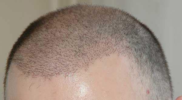 هزینه های ترمیم مو چقدر است ؟ هزینه قیمت ترمیم مو کاشت مو